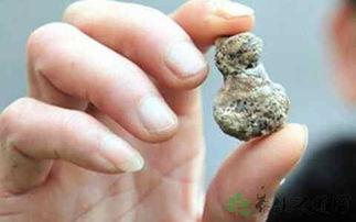 肾结石吃瓜行吗,吃瓜的利与弊